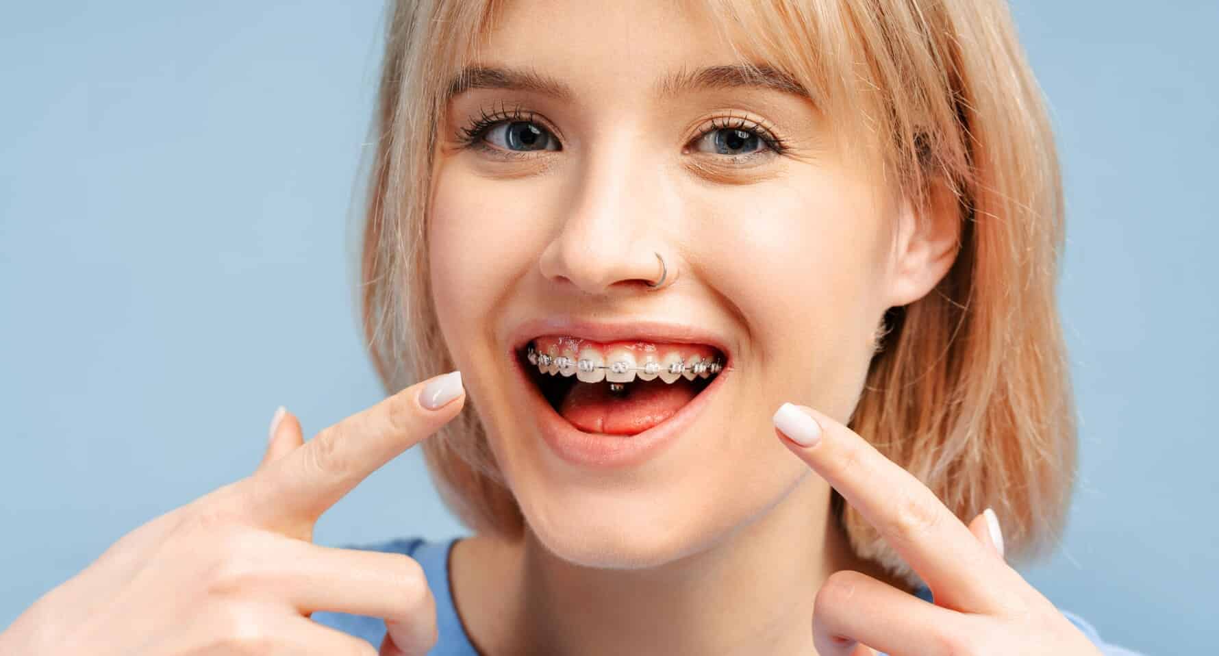 A young woman with blonde hair smiling and pointing to her teeth, showing clear braces on her upper teeth, against a light blue background.